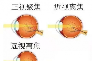 预防儿童近视 家长们要注意这三个问题